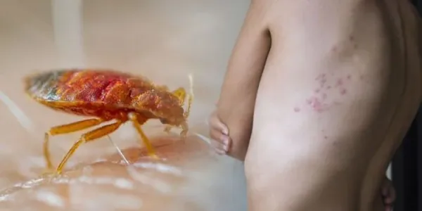 bed bug bites on skin