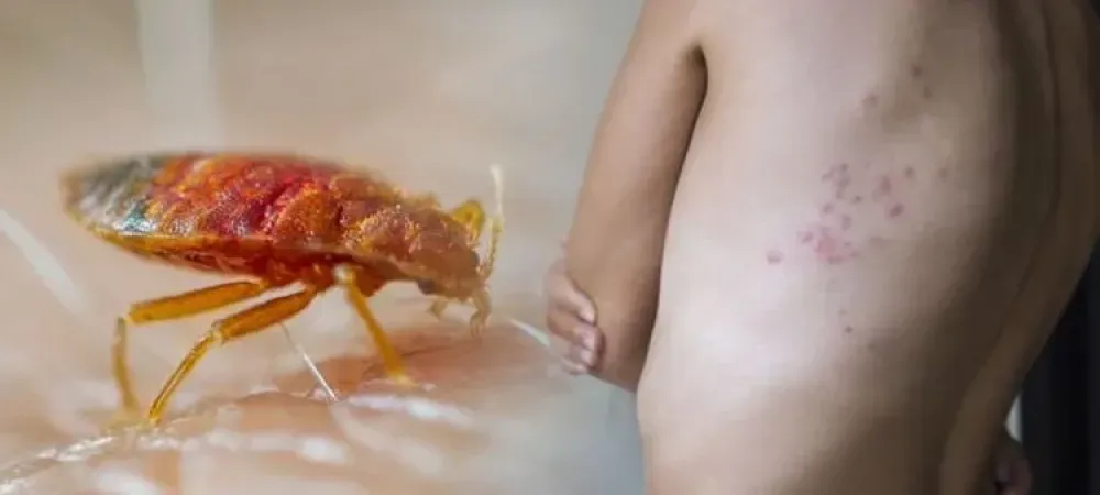 bed bug bites